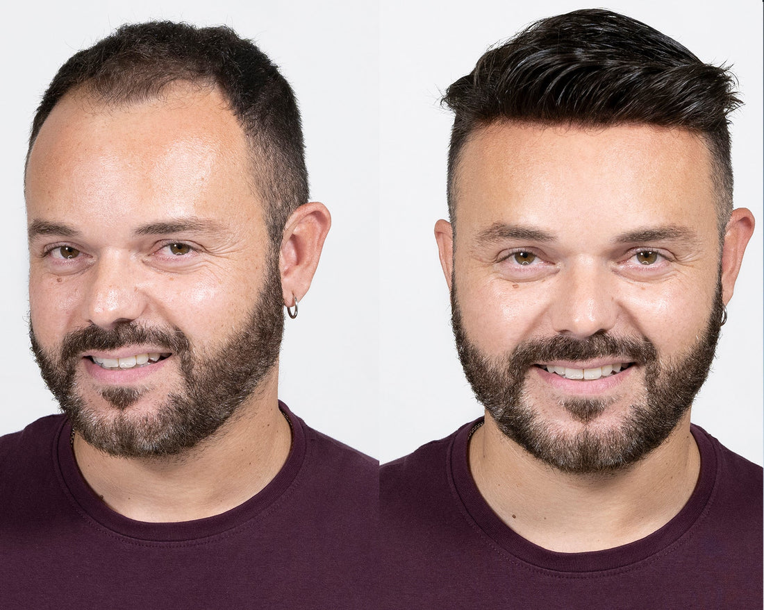 Protesi Capelli e Autostima: Come Trasformare il Tuo Look e Ritrovare Fiducia in Te Stesso